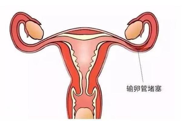 中醫治療巧囊有妙招，這兩個(gè)治療巧囊的方法記得收藏